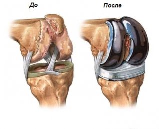 Отзывы об эндопротезировании коленного сустава