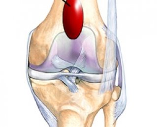 Виды бурситов коленного сустава: препателлярный, инфрапателлярный и супрапателлярный