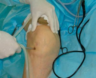 Артроскопия как эффективный метод диагностики и лечения коленного сустава
