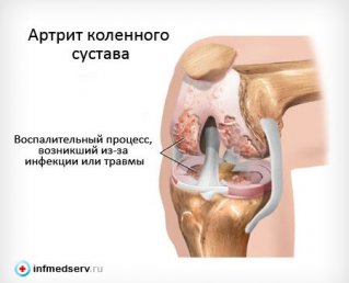 Лечение реактивного артрита коленного сустава