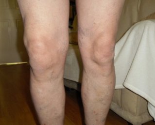 Полиартрит коленного сустава: причины, симптомы, методы диагностики и лечения
