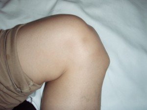 Проявление болезни Осгуда-Шлаттера коленного сустава