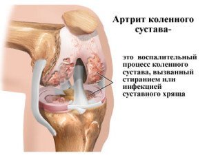 Схема артрита коленного сустава