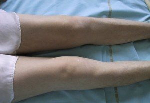 Сиптомы синовита колена