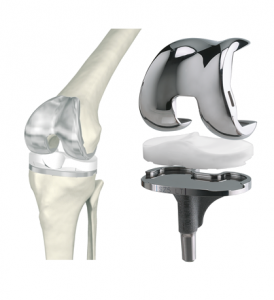 Виды протезов колена