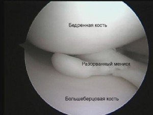 Снимок разорванного мениска в колене