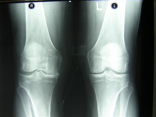 Остеоартроз коленного сустава, рентген