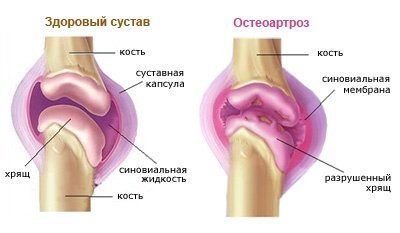 Остеоартроз коленного сустава, схема