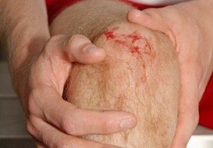 Повреждение мениска при травме колена