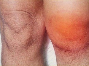 Опухоль колена при повреждении мениска