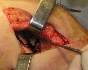 Открытая операция при разрыве связок колена