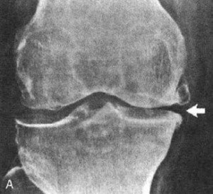 Остеосклероз коленного сустава